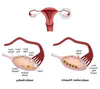 اكياس على المبايض