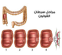 سرطان القولون